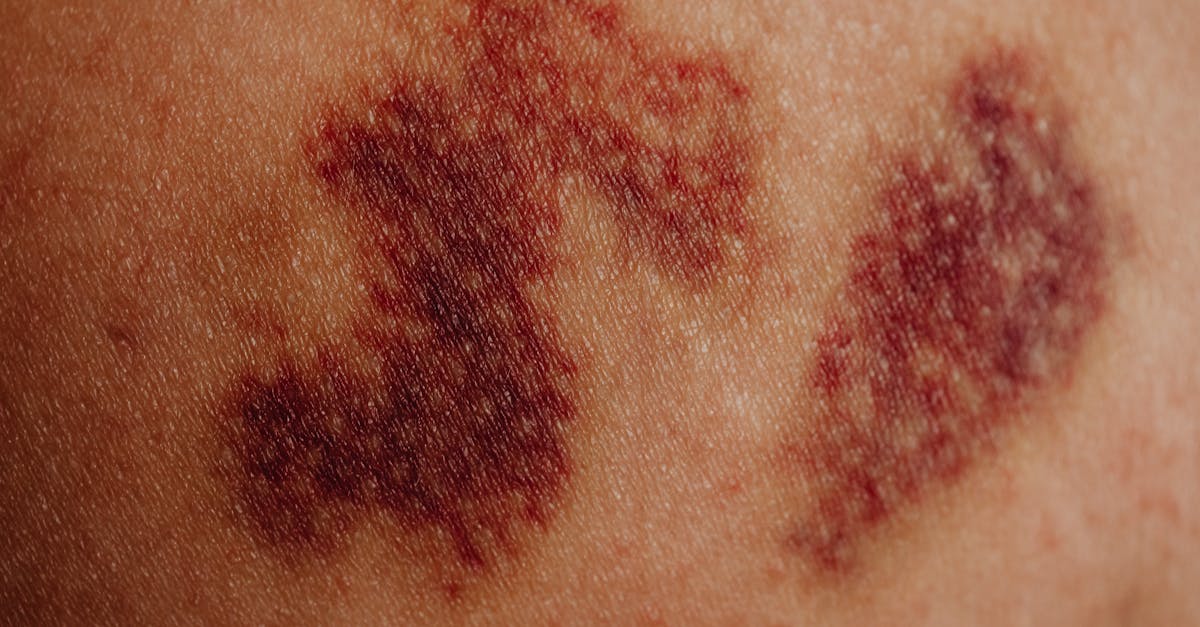 découvrez tout sur le phénomène du saignement : causes, symptômes, traitements et conseils pour gérer les situations d'urgence. informez-vous pour mieux comprendre et agir face à cette condition.